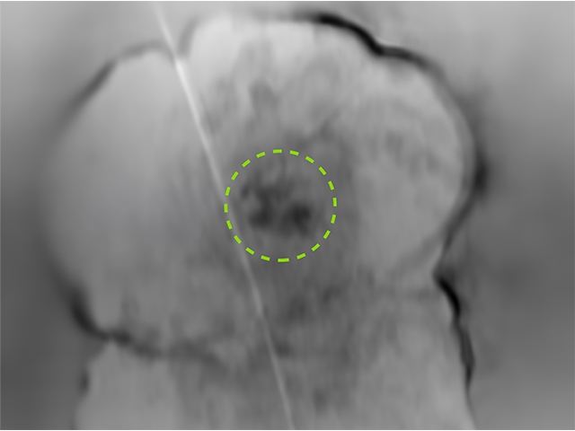 Schwarz-weiß Abbildung einer Blase von Eisen unter hohem Druck.