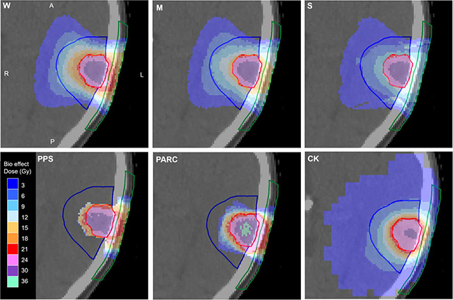 The image displays transaxial dose distributions from different radiotherapy treatment plans, arranged in two rows of colored cross-sectional head scans:  Top row (Electron irradiation with FLASH effect):      Three images (W, M, S) show dose distributions for electron beams with varying FLASH effect intensities.     Colors range from blue (low dose) to green, yellow, orange, and red (high dose).     A red contour outlines the target tumor volume, a blue contour marks adjacent brain tissue, and a green contour indicates the skin.  Bottom row (Comparison with alternative methods):      Three additional images (PPS, PARC, CK) compare other techniques: protons with passive scattering (PPS), proton arc therapy (PARC), and photon irradiation using the CyberKnife system (CK).     Dose distributions follow the same color scale as above.  Orientation markers:      Directions are labeled: A (anterior), P (posterior), L (left), R (right).