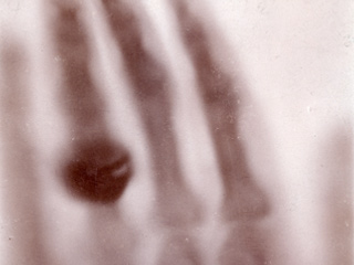 Das weltweit erste Röntgenbild zeigt die Handknochen von Wilhelm Conrad Röntgens Ehefrau Anna Bertha.